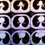 La IA podría predecir quién sufrirá un infarto